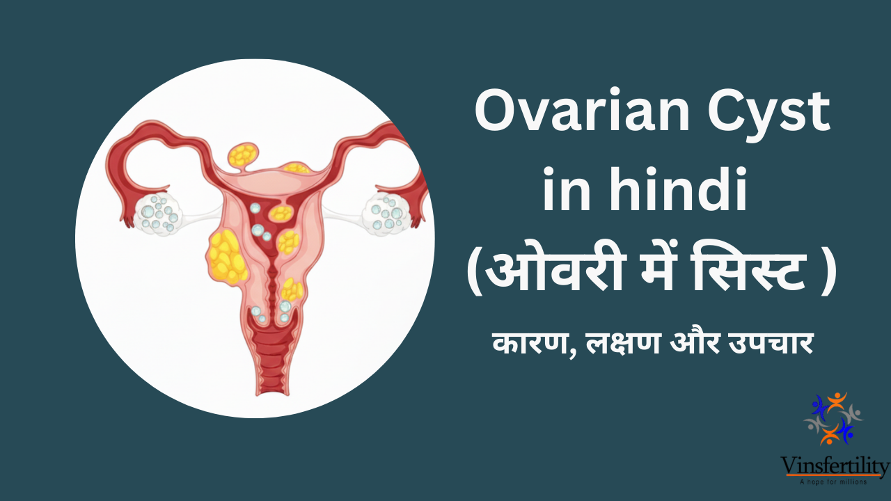 Ovarian Cyst in hindi | अंडाशय की गाँठ | कारण, लक्षण और उपचार